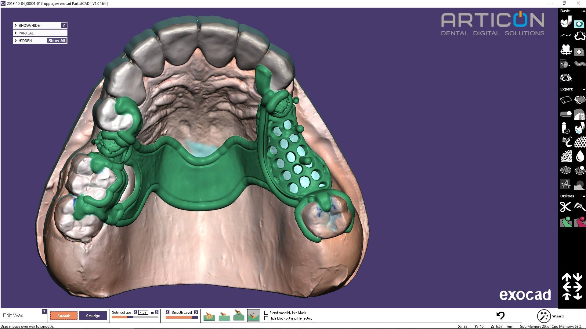 Цифровое моделирование бюгельного протеза: exocad partial cad