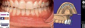 Exocad DentalCAD 2.3 Matera release